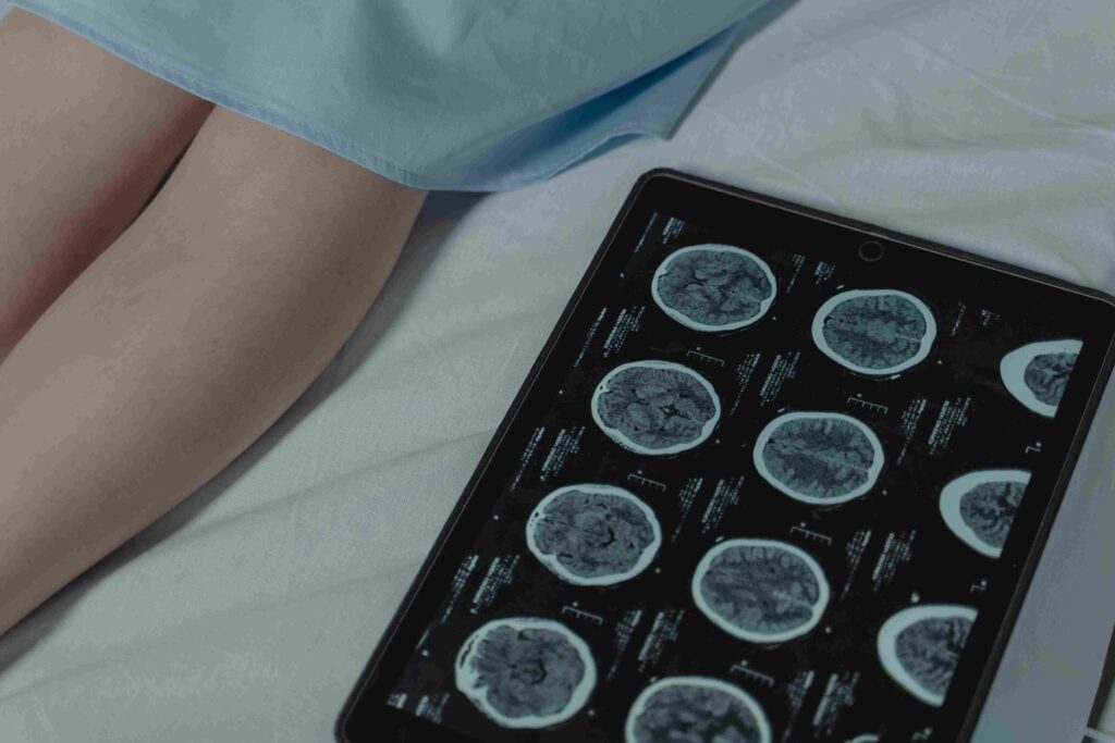 Mengenali Gejala Awal Stroke dan Langkah Pertolongan Pertama (F.A.S.T)